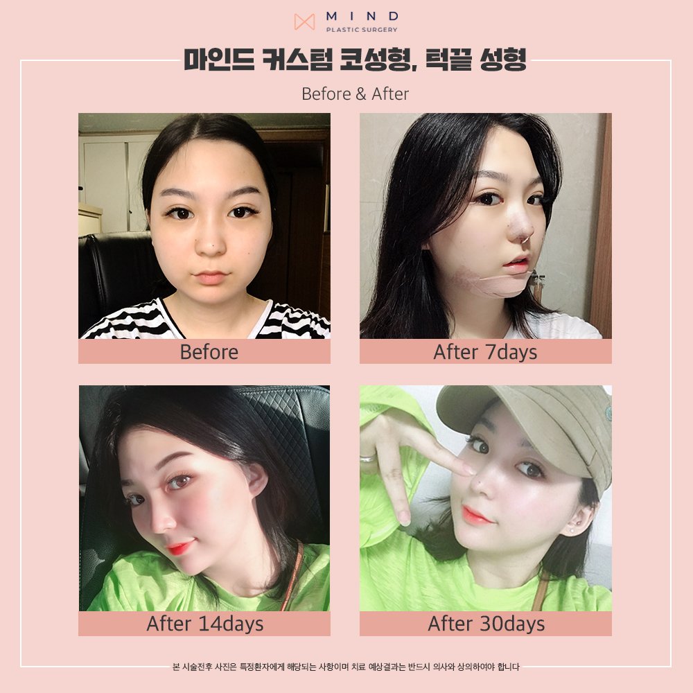 mindprs's tweet photo. 수술 부위 : 마인드 커스텀 코성형 &amp; 턱끝성형

더 많은 사진을 보고 싶다면 지금 홈페이지에 로그인 해주세요!
▶ 홈페이지 : https://t.co/ubOb1ZlH4Q 
▶ 카카오톡 :mindprs
▶ 전화번호 : 02.542.1006

#마인드성형외과 #성형외과 #서울성형외과 #신논현역성형외과 https://t.co/8ei94zeaQw