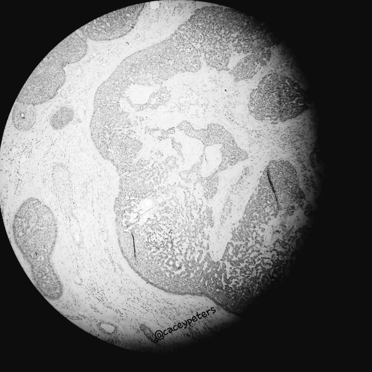 Basal moon 

#pathplanet #pathology #pathart #dermpath #astropath #microplanet #cosmicpath