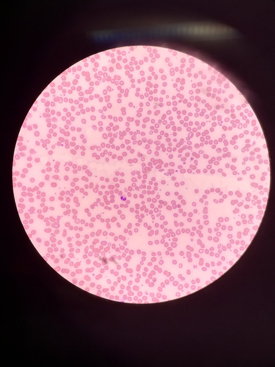 OlaYahaya's tweet photo. Did you do #steeplechase or #spottest in medical college 🎓? #nightmare It's similar to the #onefieldchallenge blood film 📸 👇
You get 30 secs to look down a microscope & state your observations
What & what can you spot in the fields? Can you characterise the tags? https://t.co/qo1pypybrH
