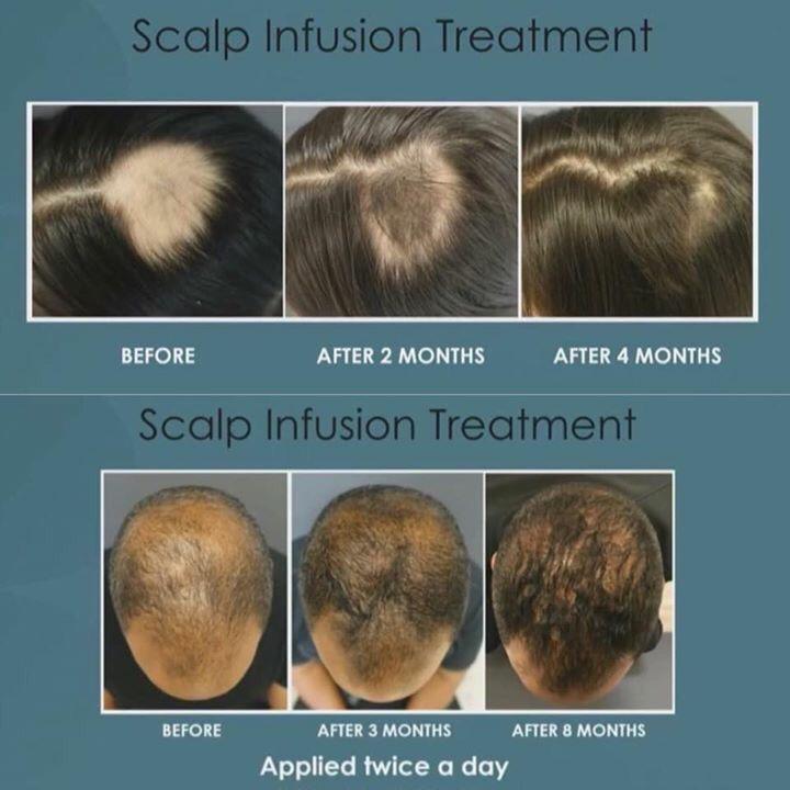 orncal's tweet photo. @vminsfatdog Hey there is a solution to hairloss (provided you still have hair follicles). Check these results out! https://t.co/yy0NUtXPic