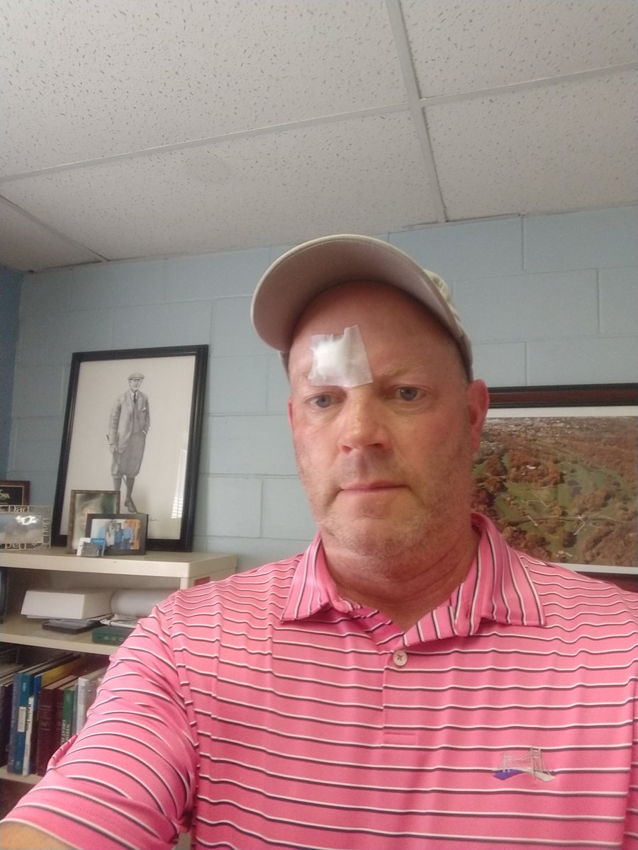 crccsup's tweet photo. 25 years ago an older member of mine at Quincy Country Club told be to apply sunscreen as he had Melanoma.  Should of listened!!  I've had 4 bouts of Melanoma and couple with Basal Cell.  Apply sunscreen people!! https://t.co/Ddjld9kOPW