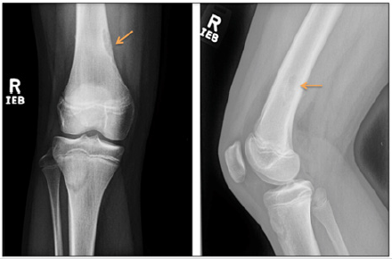 Biomedres01's tweet photo. #PathologicFracture of a #NonOssifyingFibroma by Tae H Ro*, Peter Wang BS MSIII in #BJSTR
https://t.co/IYFTxbJmWp https://t.co/B7NMY7vL8f