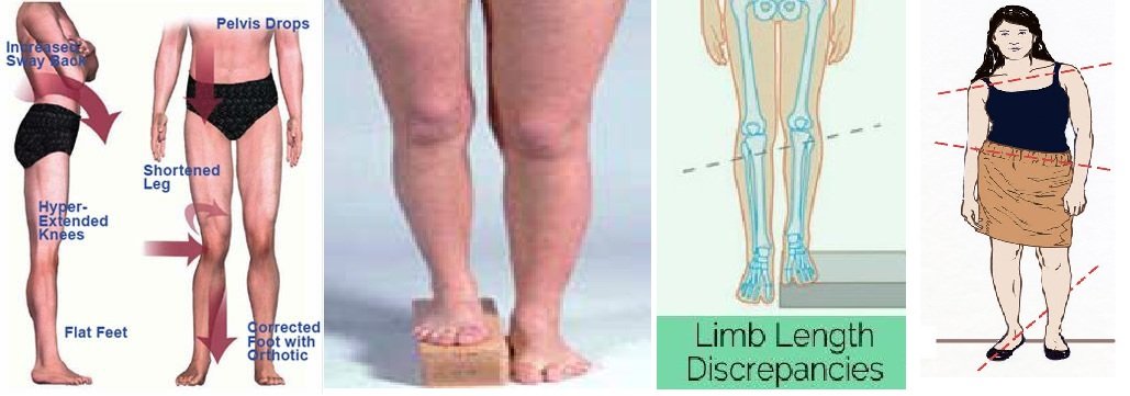 My Care Prosthetics and Orthotics on X: limb length leg length