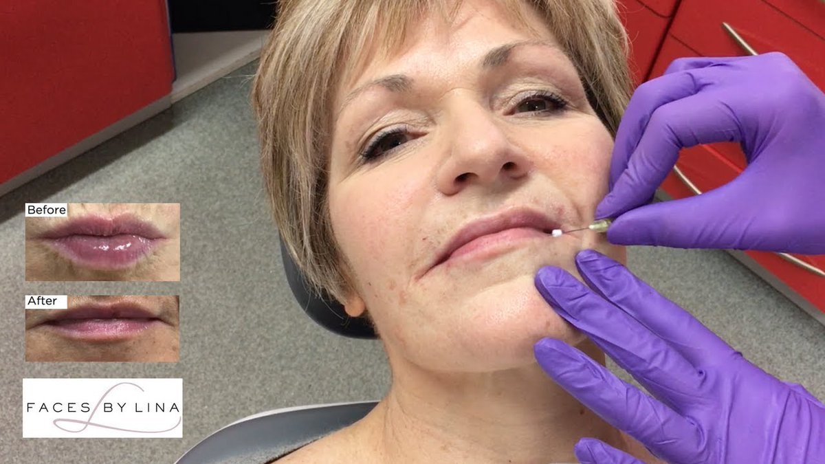 facesbylina's tweet image. Here&apos;s how easy and pain free PDO facial threads are! youtu.be/FHKOP4Ubi5U #pdothreads #facialthreads #facialaesthetics