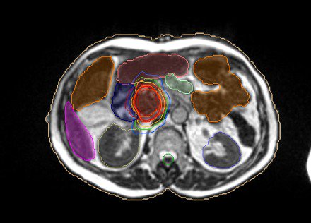 viewray's tweet photo. In-booth talk at 9:40am today, booth 500, #AAPM2019. Having MRI capabilities to see the tumor + nearby organs is key to targeting radiation dose while sparing surrounding healthy tissue. Come learn about the #MRIdian #onTableAdaptive workflow and QA for a pancreatic cancer case. https://t.co/BZ3qeYFqRZ