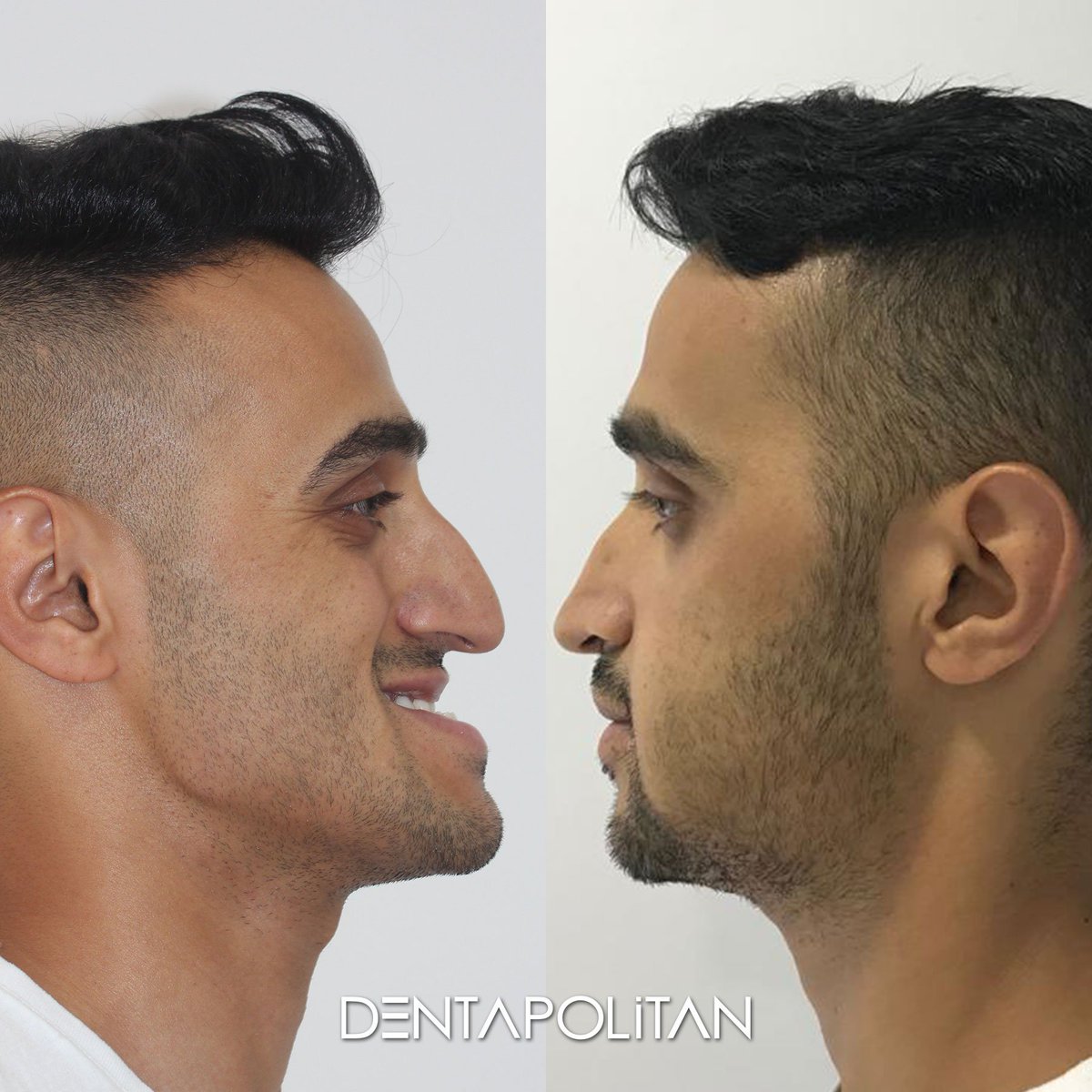 Dentapolitan's tweet image. İskelet yüz asimetrileri tedavisi en zor ortodontik bozukluklar arasında yer alır. Tüm dişleri kaplama olan hastanın ortodontik tedavisinin ardından çift çene Ortognatik Cerrahisi Piezo cerrahi yöntemi ile yapılmıştır.
#dentapolitan #piezosurgery #ortognatikcerrahi #çenecerrahisi