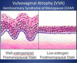 doctorneyro's tweet photo. In #GSM, after discus #risks and benefits of #vaginalhormonaltherapy, the low-dose 10-μg #estradiol or lower-dose 4 μg #estrogenvaginal insert and intravaginal #dehydroepiandrosterone (#prasterone) are options for #treatment in #breastcancer #survivors. 

https://t.co/3PCNB7cIon https://t.co/Tn90idU4sJ