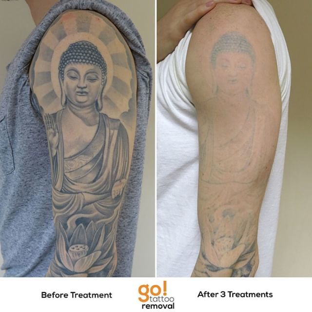 Arms  Hands Laser Tattoo Removal Before  After Results