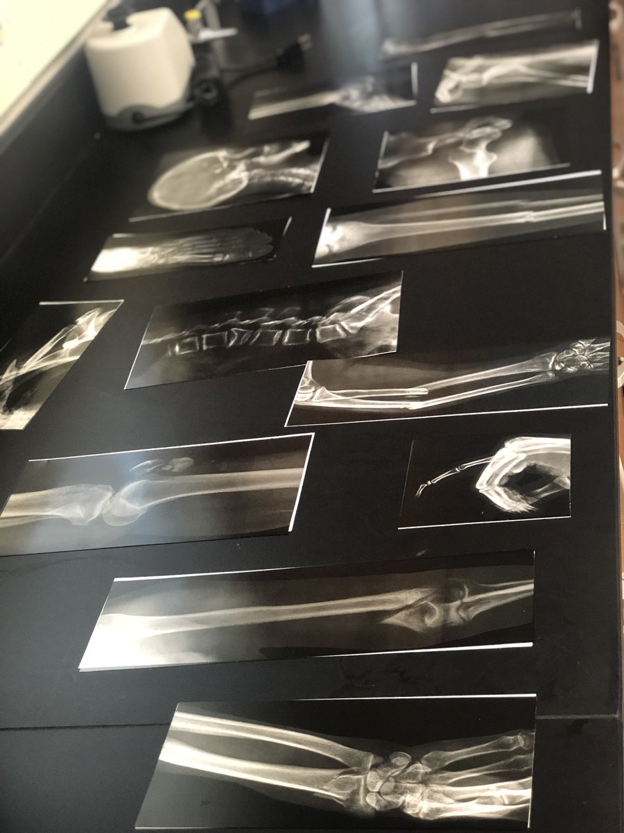 MrsTLLarkin's tweet photo. .#larkinHBSkids #jchslife ~ can you identify the bones? The fractures? And what type of fracture? You will be able to come unit 5 in HBS~ #futureisbright #learnthroughprocess #nomoretextbooksandmemorization love this @PLTWorg @BiomedSci_JCHS @UxbHSPrincipal https://t.co/vj4e9Sj81o