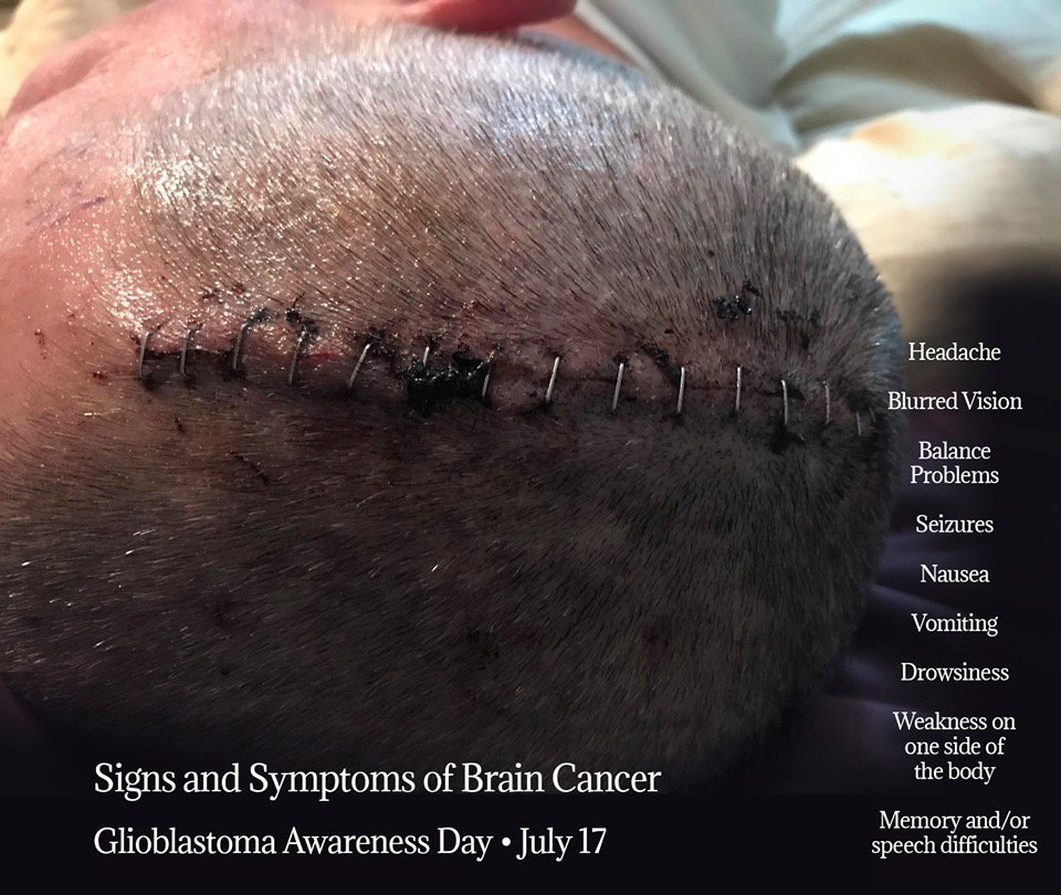OnMarch14's tweet photo. Recognize the sign and symptoms of brain cancer. Headaches and blurred vision aren't always cured by a change in glasses. 
#GBMAwarenessDay https://t.co/j97w5iKKZJ