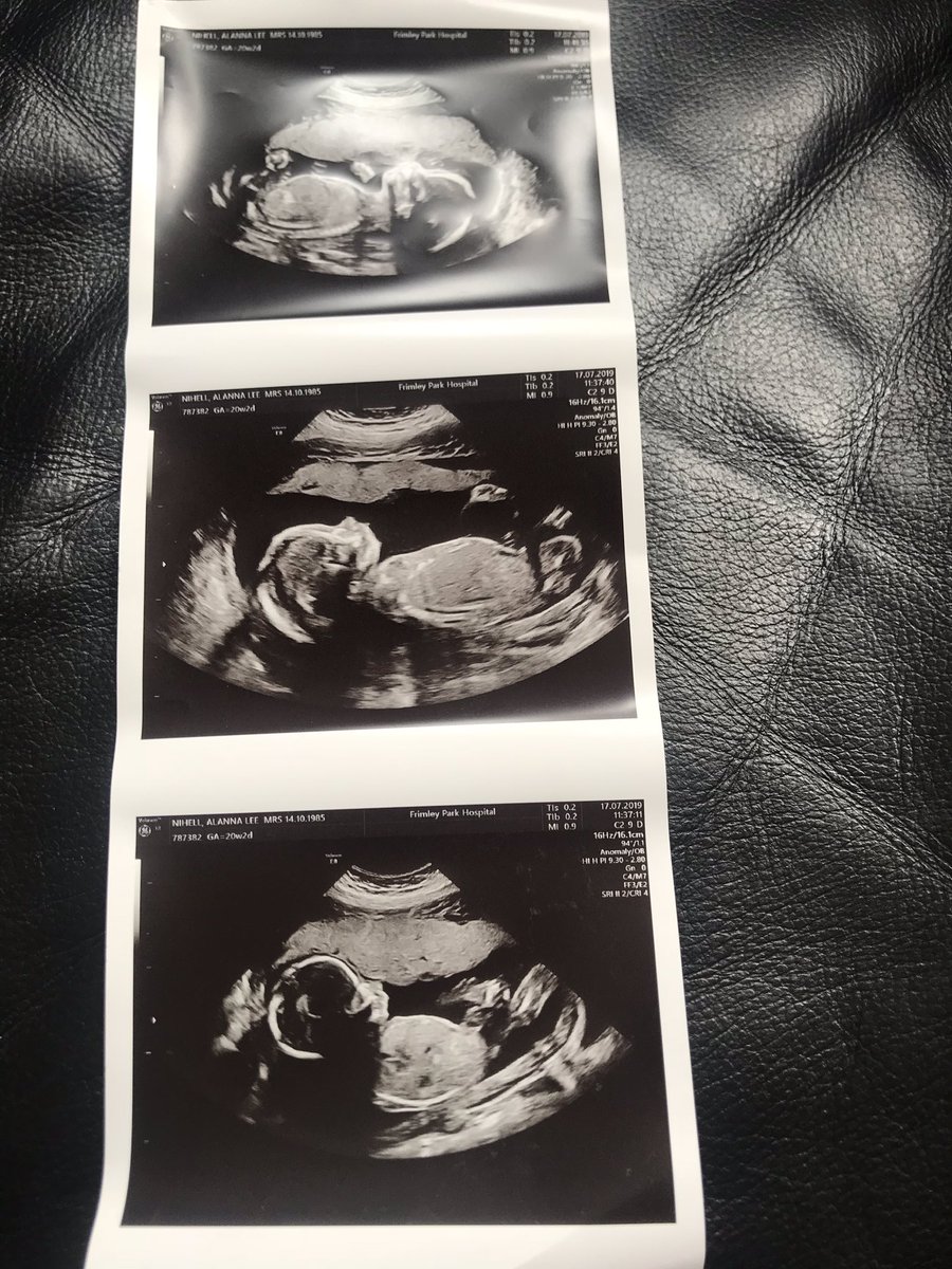 MrsANihell's tweet image. Oh Baby 👶🏼 we are half way there 💗💙 Mummy and Daddy can’t wait to me you 🌎 🌈 ❤️ #20weekscan #SoHappy #Excited #OurLittleChamp @ChezNihell