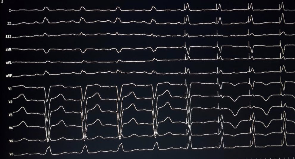 manuelpatete's tweet photo. #hispacing (19) in #dominicanRepublic threshold 2v @ 1 ms. paroxysmal AVB 40 YO. Thoughts? @Hisdoc1 @OCanoPerez @MdHuang @vivasfhrs @DRDIEGOQRS @drluissaenz https://t.co/a58BWbXAMx