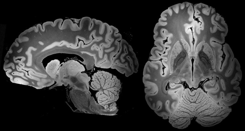 TellMp's tweet photo. A 100-hour MRI scan captured the most detailed look yet at a whole human brain #neurology https://t.co/8plHtndiOi https://t.co/QQmCZWFiE2
