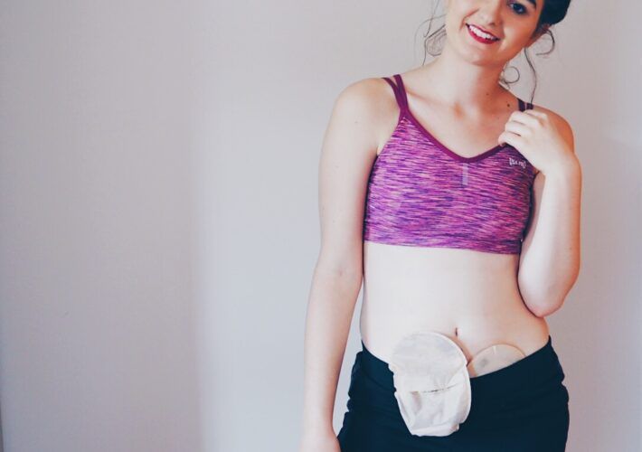 katieemay1's tweet photo. It's crazy to think I've had my stoma for over 4 years! Here's a little post with some of the things I've learnt in the past 4 years 💜 https://t.co/rPZkybZT2D

@OneStopStoma #ostomy #ileostomy #stoma #ostomate #GYBO https://t.co/WHiS2cLTcT