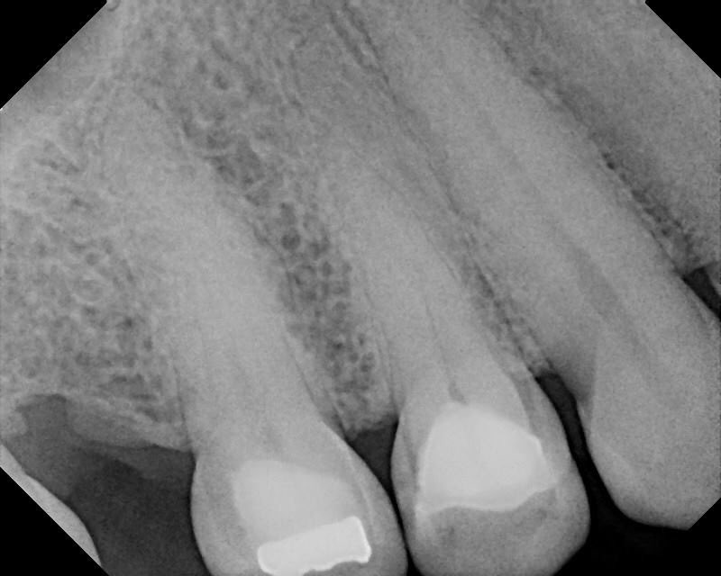 DrRicoShort's tweet photo. The SHORT Case Of The Day!
Wednesday Curves~~~ #4,#5,#18
Them boys tight! Look at the curves on those roots! You can do this too if you pick the right weapon for the battle! I’ll teach ya! Hands-On courses coming soon! #EndoArt #VortexBlue #OneVisit
#WorthSaving #WarmVertical https://t.co/WcMONBhnpO