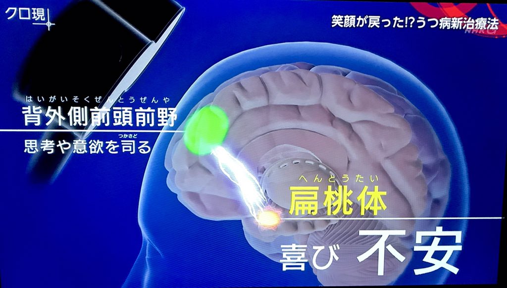 慢性疲労症候群 を拡散して委員会 Tms治療 鬱病の治療では 背外側前頭前野 Dlpfc に磁気刺激を与えるのは 私が 慢性疲労症候群 の治験で受けた部位と同じようです 私は左眉辺りにデコピンされてる感覚でしたが 番組では左右の額辺りに刺激を送って 慢性疲労症候群 を拡散して委員会 Tms治療 鬱病の治療では 背外側前頭前野 Dlpfc に磁気刺激を与えるのは 私が 慢性疲労症候群 の治験で受けた部位と同じようです 私は左眉辺りにデコピンされてる感覚でしたが 番組では左右の額辺りに刺激を送って