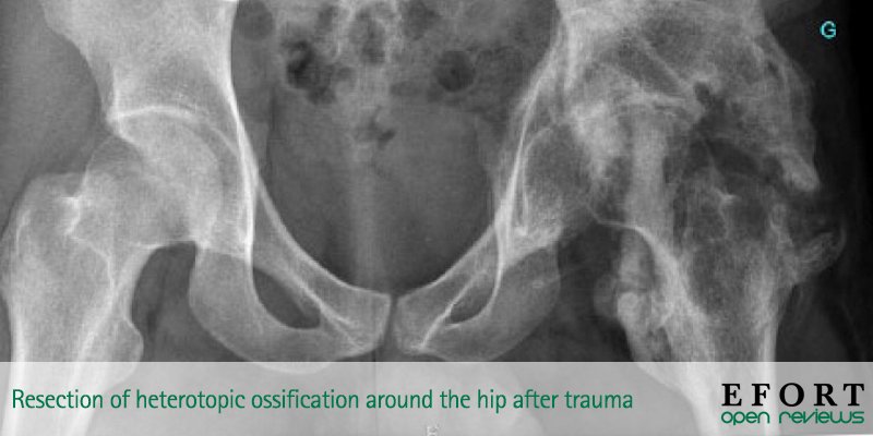 EFORTnet's tweet image. 📄Resection of heterotopic #ossification around the #hip after #trauma bit.ly/2FRwh8h  
📗Find all #EFORT2019 Instructional Lecture bit.ly/2FCdo95 
#OpenReviews #surgery #spine @BoneJointJ @NicodelEsc