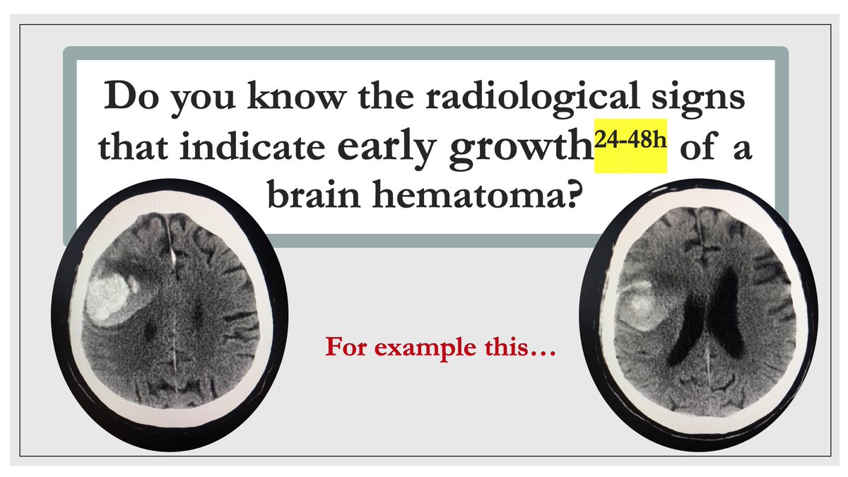 teachingradiol1's tweet photo. Neuroradiology #foamrad #neurorad #neuroradiology #haematoma #signs #edir #SERAU @vmargar @SERAUWeb @ESERadiology @canariaderadio1 https://t.co/PDSuLrDHsh