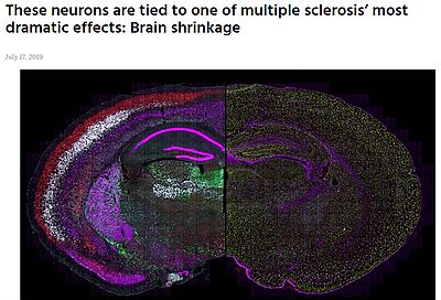 PaediatCam's tweet photo. "These neurons are tied to one of multiple sclerosis’ most dramatic effects: Brain shrinkage", with quotes from #DavidRowitch. https://t.co/qHnfrw5Nlq #MultipleSclerosis https://t.co/L27xj15bVU