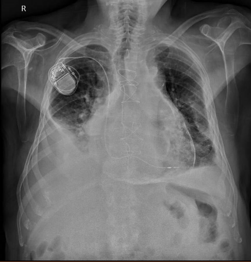 Imagencardio's tweet photo. ⭐️⭐️⭐️TEACHING CASE⭐️⭐️⭐️
Constrictive pericarditis with extensive pericardial calcification. PE as an incidental finding causing right failure @secardioCRMTC @wikimagen @danilorenzatti @CSmuclovisky @purviparwani @LopezOpitz @GuzmnNy @ElenaRefoyo @HUReyJuanCarlos @venkmurthy https://t.co/DxzyOTfV9n