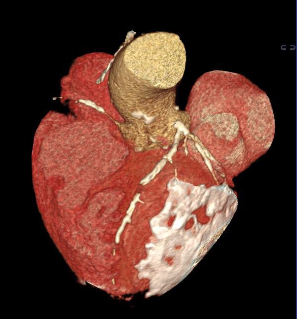 Imagencardio's tweet photo. ⭐️⭐️⭐️TEACHING CASE⭐️⭐️⭐️
Constrictive pericarditis with extensive pericardial calcification. PE as an incidental finding causing right failure @secardioCRMTC @wikimagen @danilorenzatti @CSmuclovisky @purviparwani @LopezOpitz @GuzmnNy @ElenaRefoyo @HUReyJuanCarlos @venkmurthy https://t.co/DxzyOTfV9n