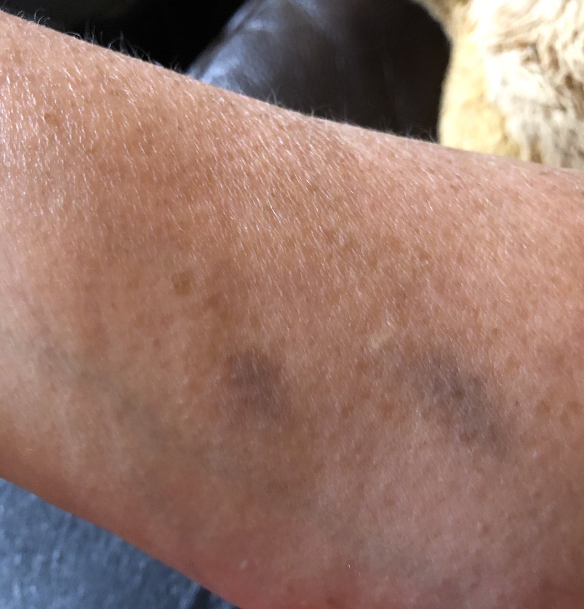 This is what happens when you play tug of war with a retired police dog and she accidentally gets your arm 🤣  #RPDKeach @polscotdogs #ShesStillGotIt 🤣🐾💙🐾