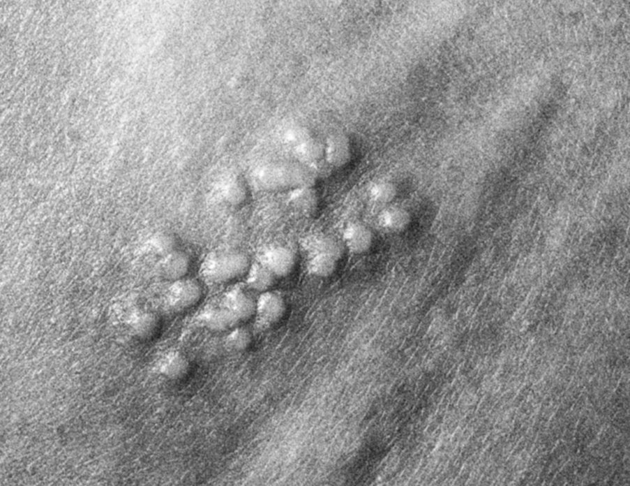 team_caduceus's tweet photo. Herpes Simplex Virus -2 https://t.co/ltNSGeqKOV https://t.co/x2bf4bbWwz