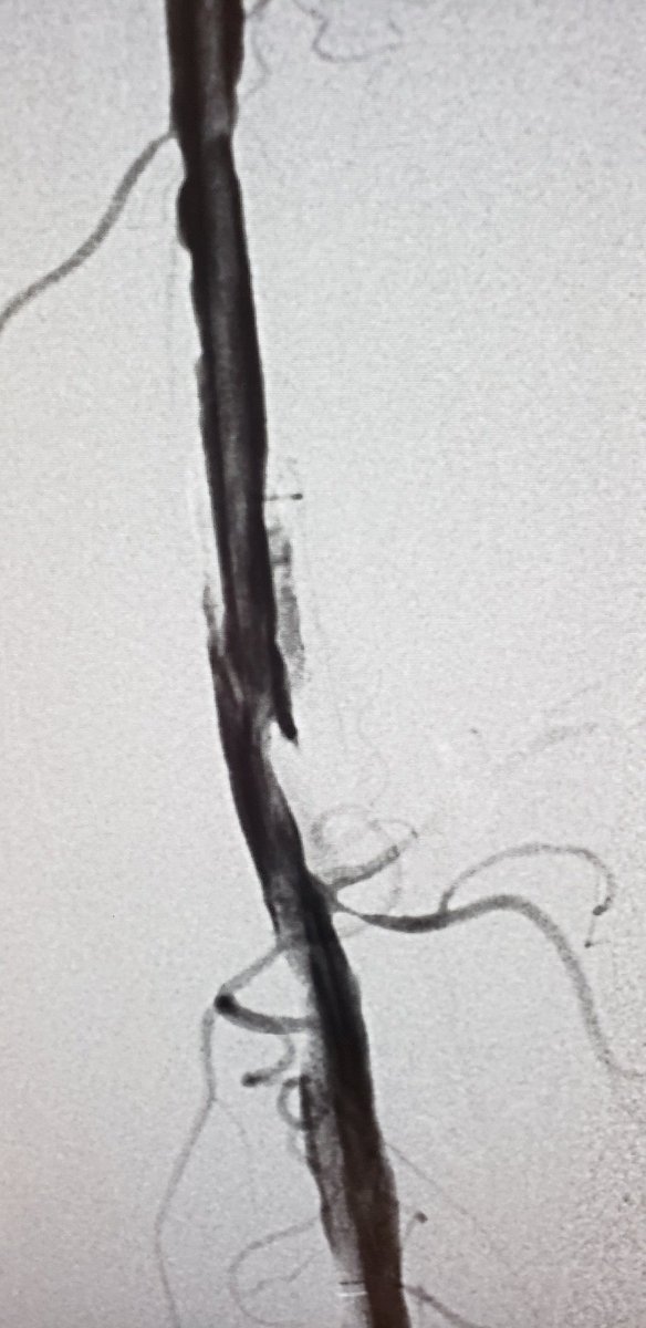 JRUNMD's tweet photo. SFA after PTA and after IVUS guided focal dissection repair .. these legs were made for Tacking! #intactvascular #aivsllp https://t.co/R9p3X5ZJKb