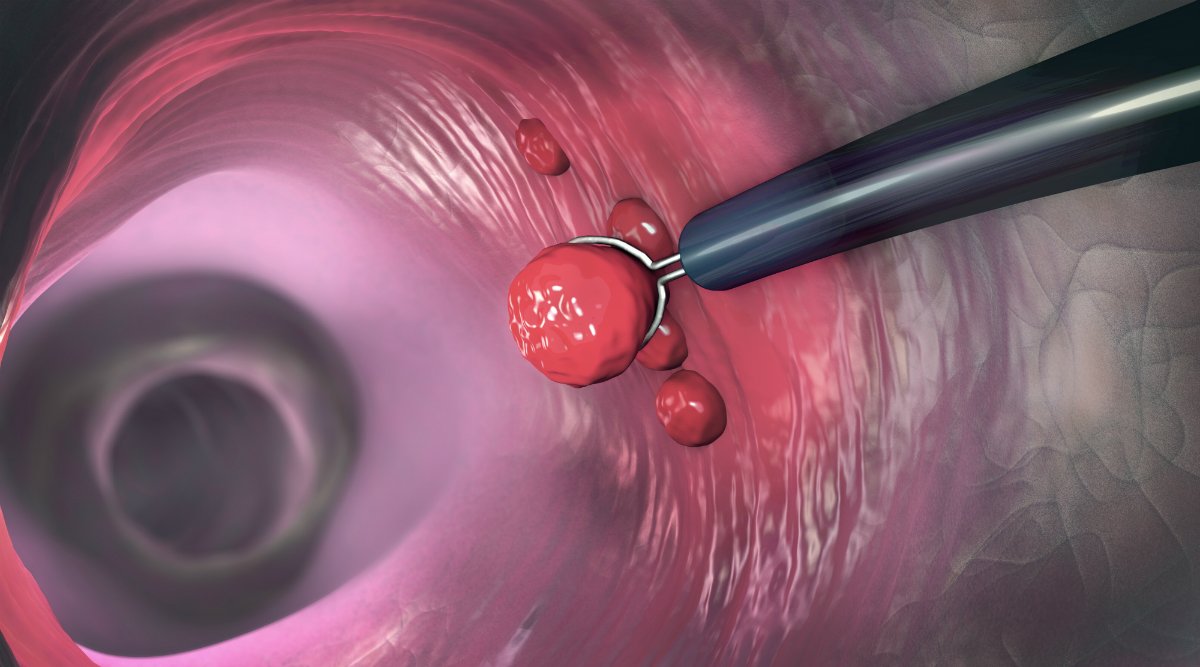 AnnalsofIM's tweet image. Here's an #AnnalsPatientSummary to share: Heparin Bridging and Hot Snare #Polypectomy in Patients on Anticoagulants With Subcentimeter Polyps ow.ly/PfWJ50v4X3I.