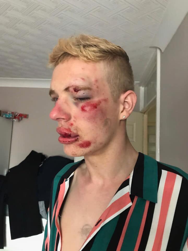 #RyanWilliams, abita a Preston nel Regno Unito, ha 22 anni ed è stato preso a botte solo perché gay. Lo sfogo che ha postato, con l’immagine del suo volto coperto di sangue, è diventato virale. 
Ma “l’omofobia non esiste”, dicono