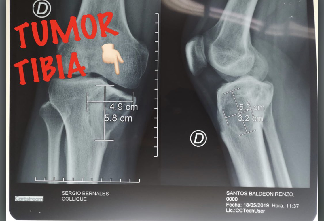 KCA1901's tweet photo. #HospitalNegreiros realizó el 1er ALOINJERTO ESTRUCTURAL en un Tumor de Tibia en paciente de 24 años, el primero en un Hospital II Traumatologos altamente capacitados!#RepotenciandoRedSabogal #esSalud #SeguimosAvanzando @EsSaludPeru @FioreMolinelli https://t.co/rbzX4wx4ju