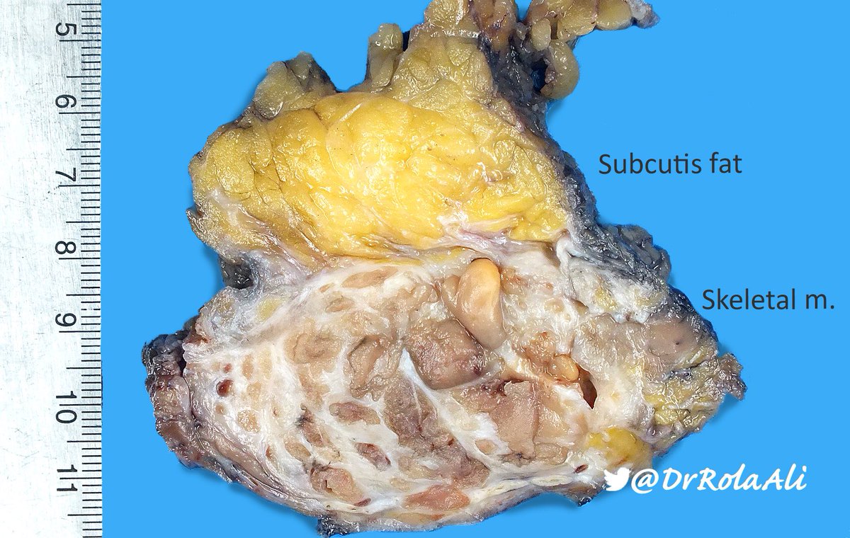 DrRolaAli's tweet photo. 1/4
Abdominal wall lesion in a female
Endometriosis?
#RolaCoaster #gynpath
@slusagar @Pathmath1 @PathologySayah @DrMarkOng @kis_lorand @kriyer68 @ariella8 @Chucktowndoc https://t.co/ojtHyqbJRH