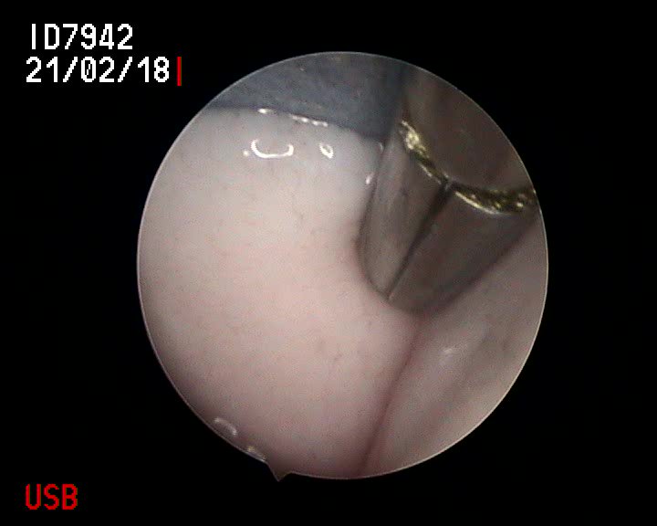 Astonishing - but heartening - to learn that advanced medical procedures like keyhole surgery are now being widely used in #aquaculture, including - for the first time, by a pioneering vet <a href="/SwanseaUni/">Swansea University</a> - in #lumpfish production thefishsite.com/articles/how-k… #wales