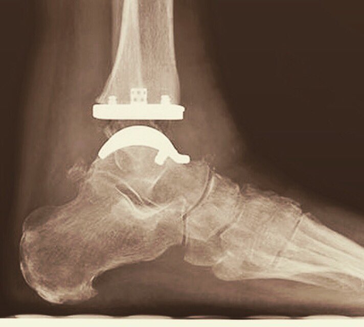 #new #anklereplacement for #ankle #arthritis