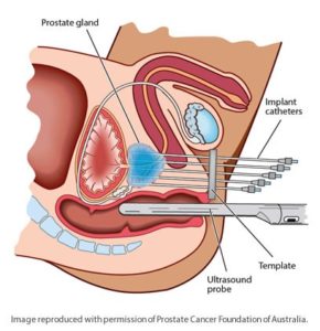 procancerexpert's tweet photo. For #HdrTherapyinFortLauderdale Contact The World Best Prostate Cancer Experts at 954.492.5764. Visit: https://t.co/qfa9DOajtW https://t.co/Lko1rCQtPf