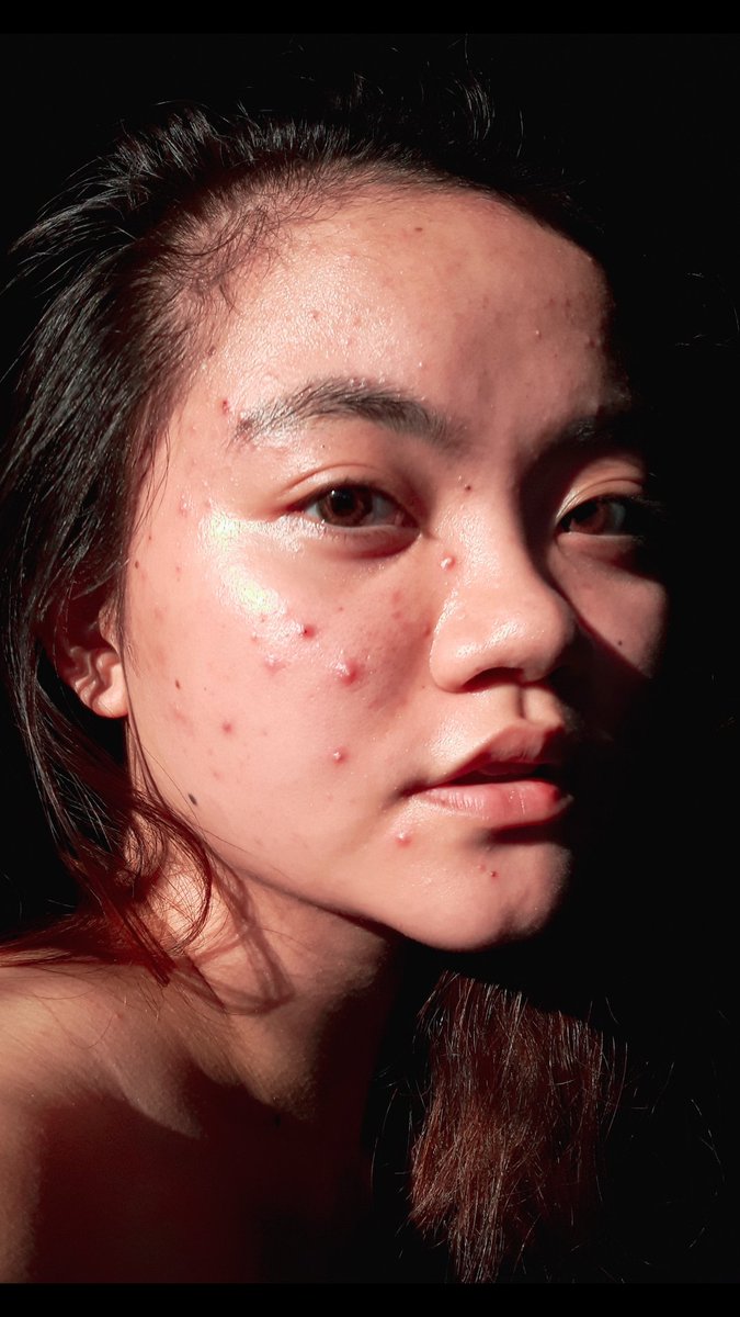 ViaWurtzbach's tweet photo. 🌼 acne prone but make it fashion 🌼

Here's to deciding to live with it, make peace with it, and accept it.This is me flaunting my red spots to the patriarchy like the combination-skinned woman that i am. 

Also tbh, i woke up like this 💋 https://t.co/CAYoLSqN7Y