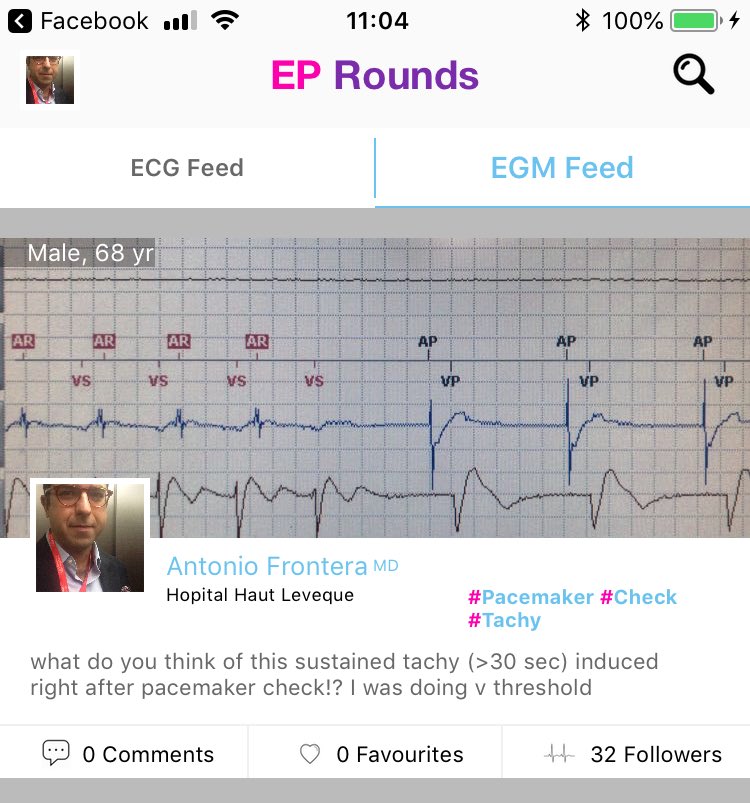 sozi81's tweet photo. Another egm case added on #eprounds. This is mine. Sustained tachy induced right after V threshold. Any clue!? Download it on your mobile and add your comment @DrRoderickTung @EF_Cardiaca https://t.co/OGNx2bQCLY