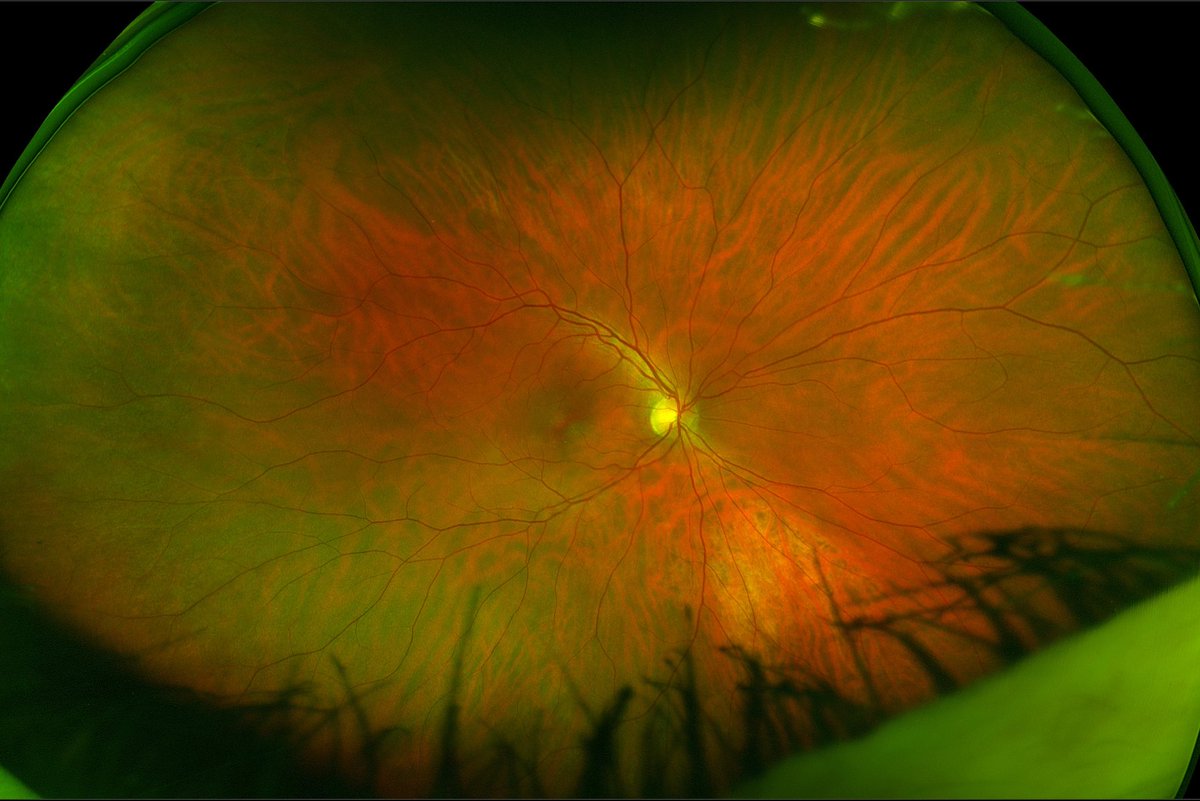 eyeFXtweets's tweet image. My eye image
Thank you @optomap for scanning my eyes.
On the @eyeonwopec stand D71 @optrafair 
Visit us and learn with WOPEC @SchoolOfOptom