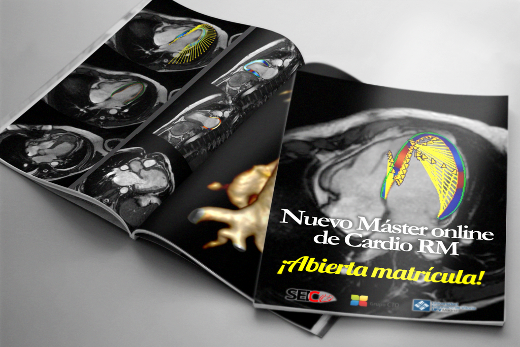 Radiólogos y cardiólogos unidos para enseñar todo sobre la cardio resonancia magnética.
Abierta la matrícula para el nuevo Master online de Cardio RMN del Campus SEIC_CTO buff.ly/2vofas3
No pierdas la oportunidad de convertirte en un experto
Cada vez quedan menos plazas