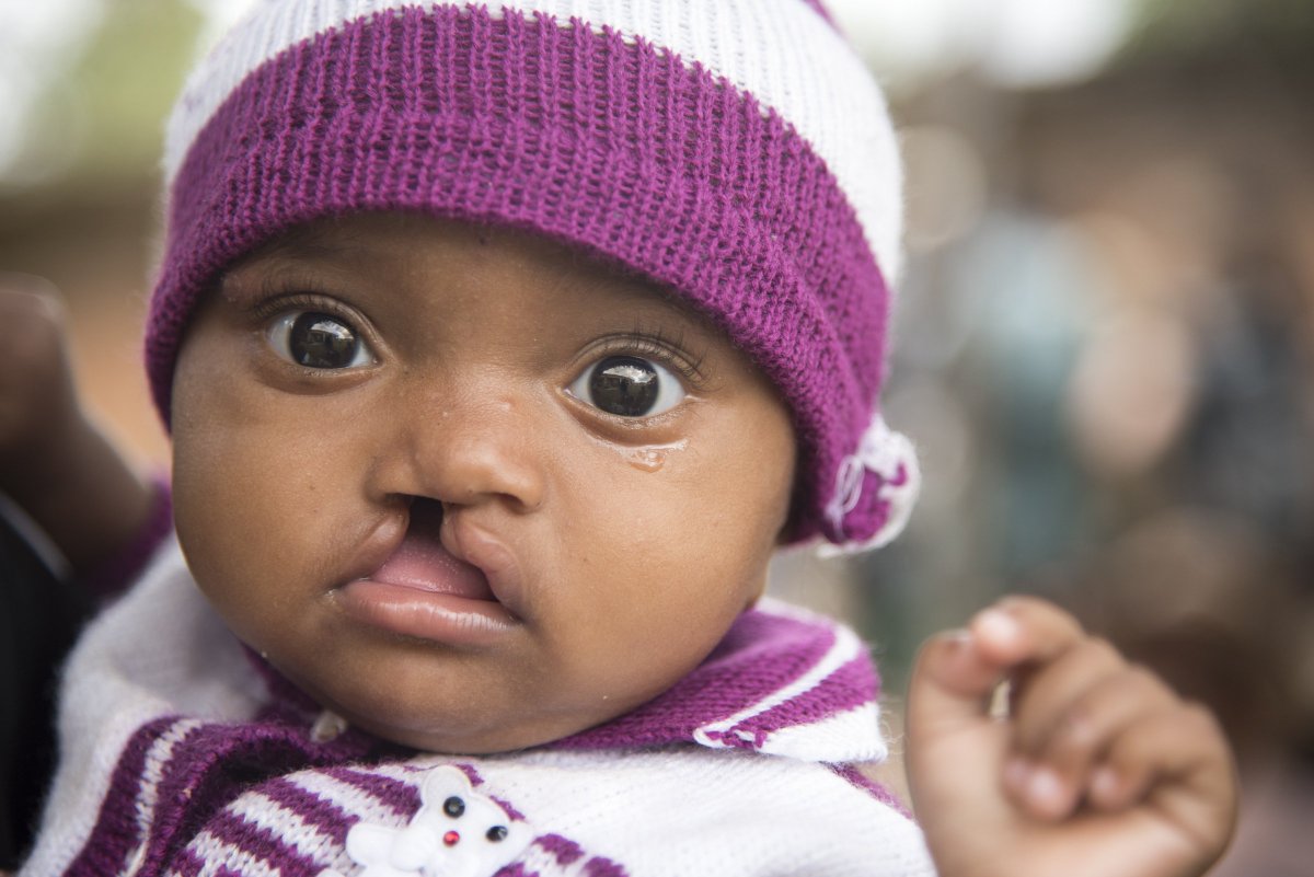 operationsmile's tweet photo. Today, patients like Larissa are waiting to see if they'll receive surgery during our mission in #Madagascar. Unfortunately we can't treat every patient this week, but we will keep coming back until no child suffers from lack of access to surgery. #mega4 https://t.co/svRef0SrmT