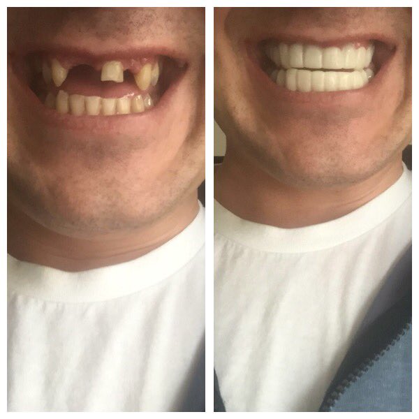 Dean beleidigen Heldin clip on veneers schlechter machen Tschüss Großhirn