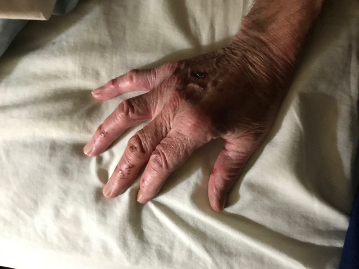 Looking better! Sore as hell