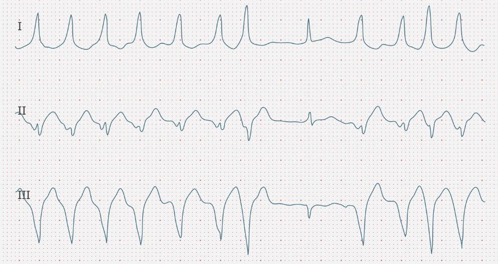 ecgbuddy's tweet photo. It's Monday, time for a new ECG case!! This 48 y/o patient feels dizzy. What’s your diagnosis? Hint:episodes of palpitations for many years.#mondaymotivation #ECG #ecgbuddy #studybuddy #ecginterpretation #emergencyroom #hospitallife #medicalstudent #medschool #medicallife #ERlife https://t.co/QwzokQl4iu