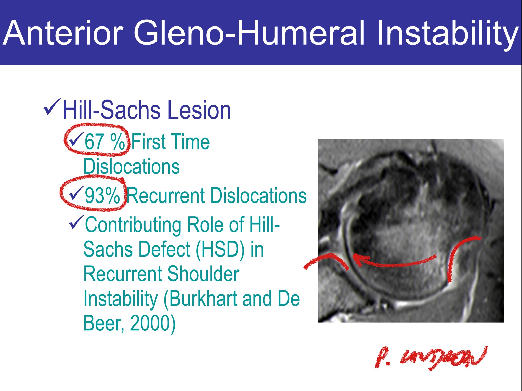 Philippe Landreau, MD on X: Hill-Sachs lesion definition. Just to be sure  everyone is ok with that. 😊  / X