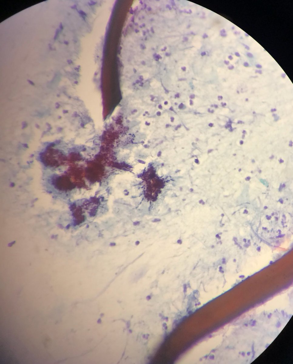 MoharramDr's tweet image. Hellow #pulmonarypath this FNA is from left lung lesion 22 y male history of trauma?
There are many foreign material fragments, inflammation, histiocytes and the microorganism below. Any idea what are they ? @yro854 @smlungpathguy