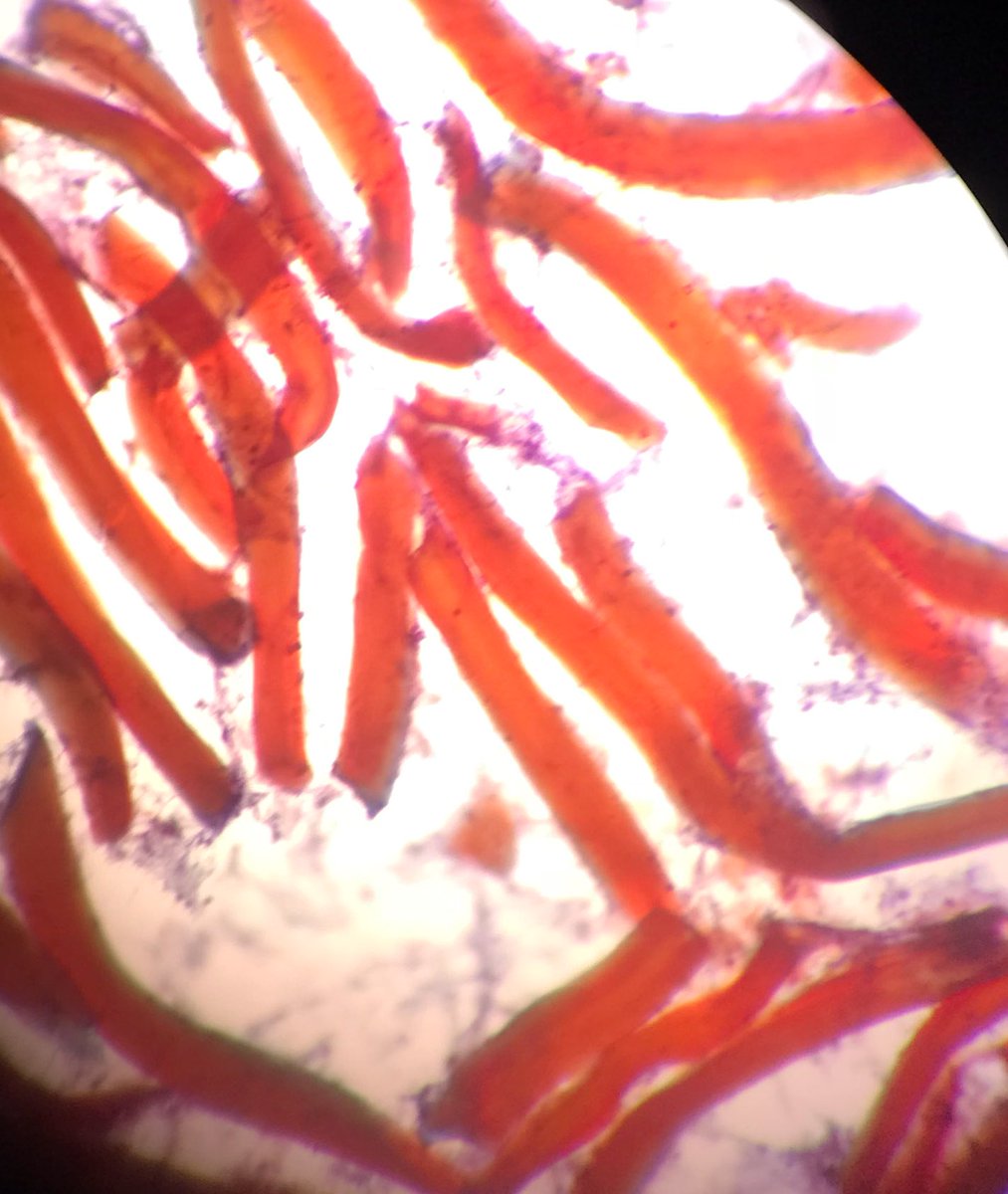 MoharramDr's tweet image. Hellow #pulmonarypath this FNA is from left lung lesion 22 y male history of trauma?
There are many foreign material fragments, inflammation, histiocytes and the microorganism below. Any idea what are they ? @yro854 @smlungpathguy