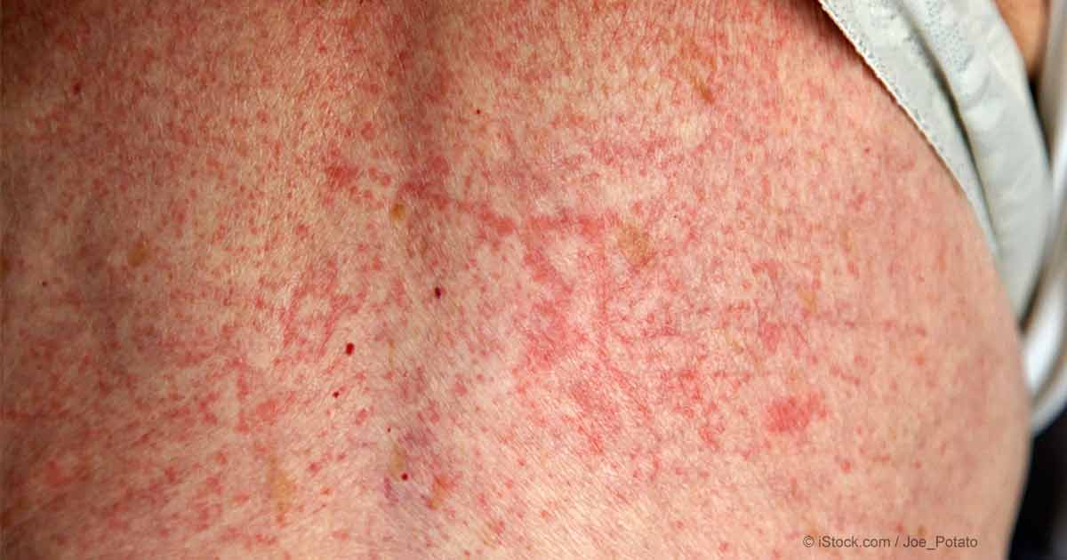 Kristen Alison On Twitter Sulfaallergy Sulfa Allergy Occurs When A Person Has An Allergic Reaction To Drugs That Contain Chemicals Called Sulfonamides For More Visit Https T Co 7wyqgie2lk Pharmaconferences Pharma2018 Pharmaceutics2018