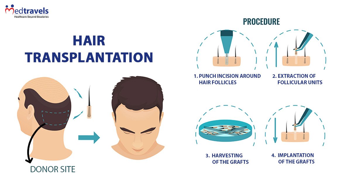 Medtravels_in's tweet image. #HairTransplantation is a #SurgicalSystem that expels hair follicles from one part in the body, called the &apos;donor site&apos;, to an uncovered or thinning up balding part of the body known as the &apos;recipient site&apos; bit.ly/2H0OK4I
#MedTravels