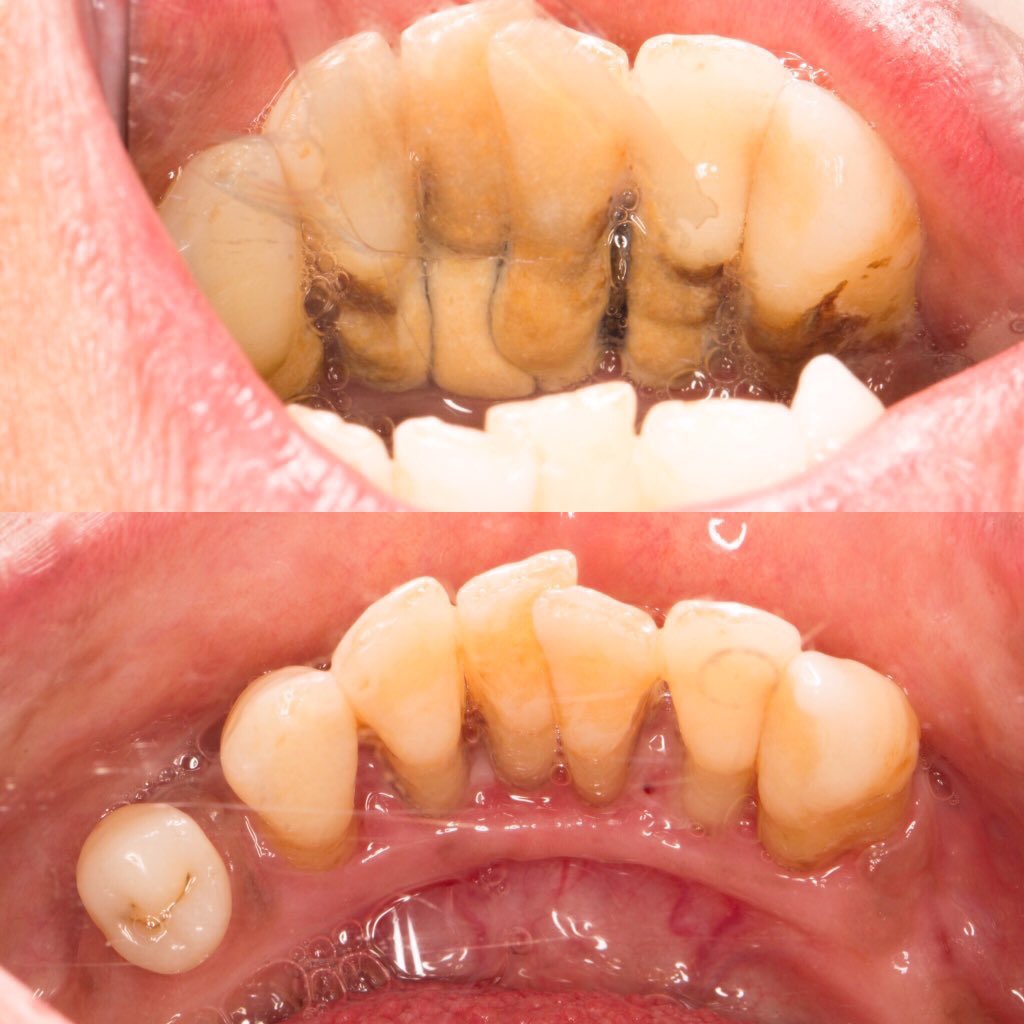 Qu Dentists on Twitter: "Calculus bridge scaling done by: @SomayaGarawi