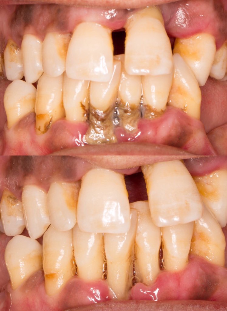 Qu Dentists on Twitter: "Calculus bridge scaling done by: @SomayaGarawi